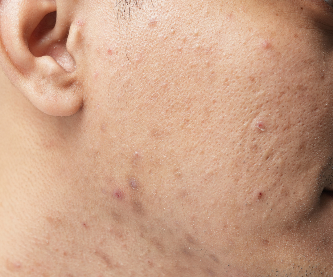 How can you tell if your acne prone skin is too sensitive for acids?