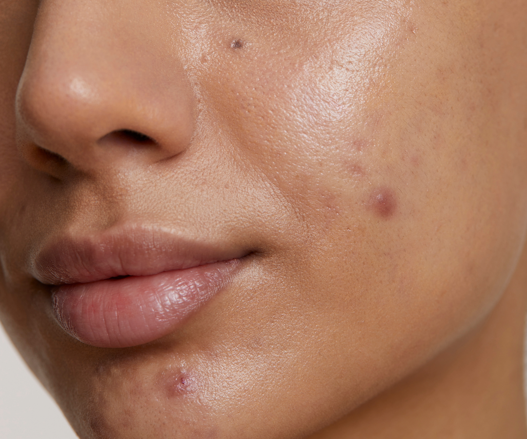 How to identify & get rid of acne marks (PIE vs PIE)?