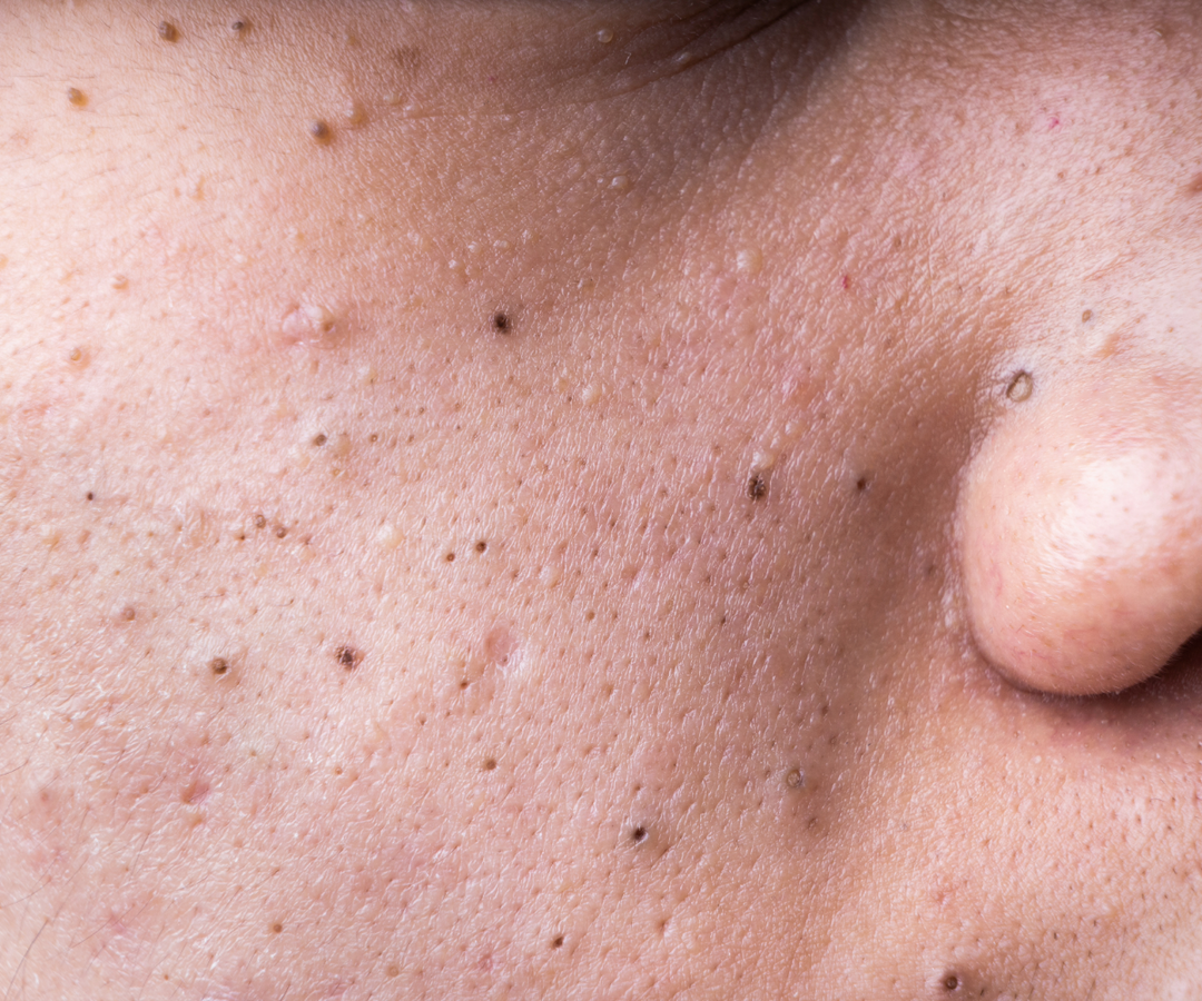 Say Goodbye to Blackheads: Effective Methods for Clearer Skin