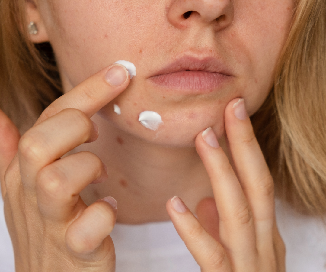 How to select the right acne treatment?