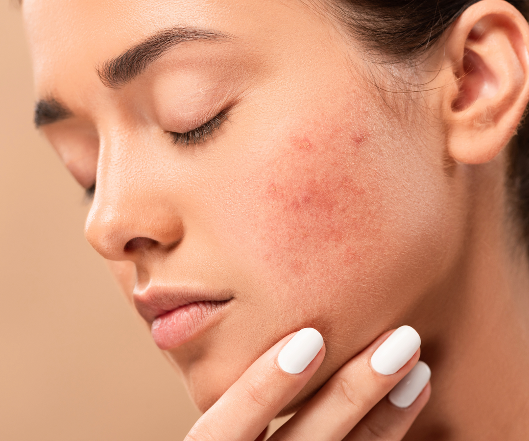 How to get rid of acne?