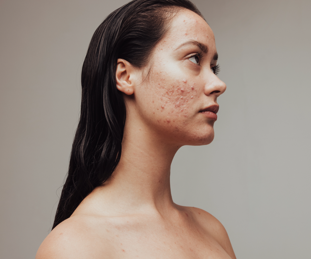 Acne Solutions Hub: Your Go-To Resource for Managing Breakouts