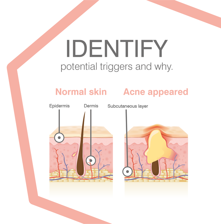 12 week Skin Journal | Track and beat breakouts